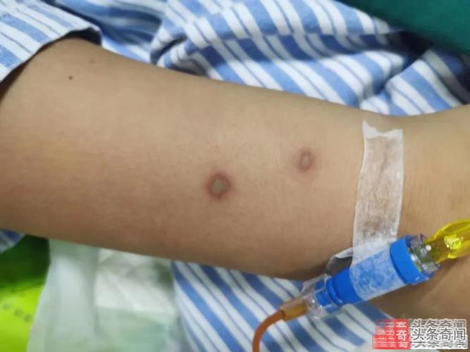 女童被蜜蜂蛰伤致死
